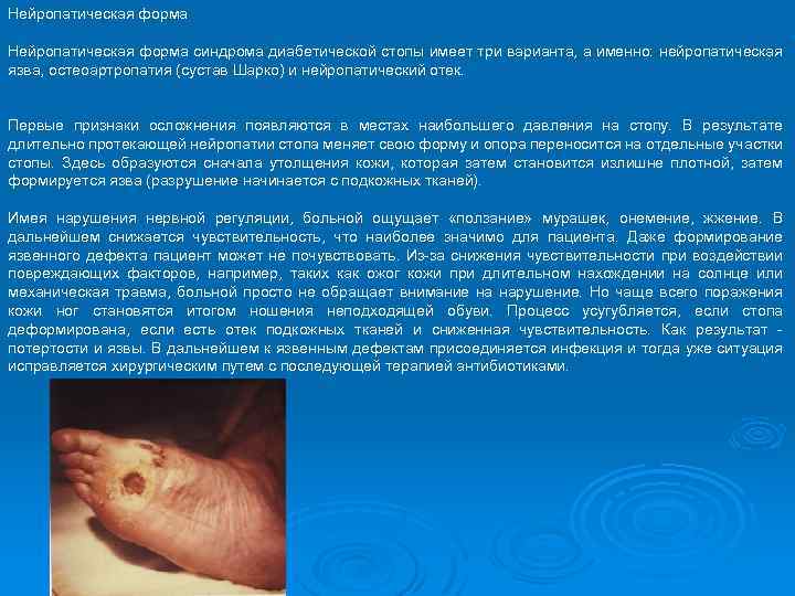 Нейропатическая форма синдрома диабетической стопы имеет три варианта, а именно: нейропатическая язва, остеоартропатия (сустав