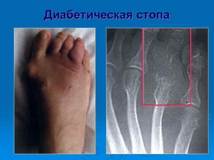 Диабетическая стопа 