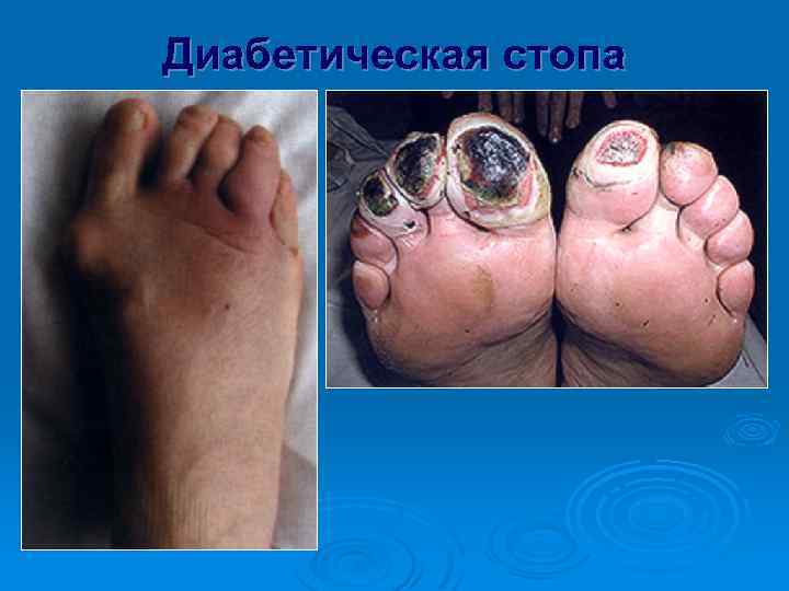 Диабетическая стопа 