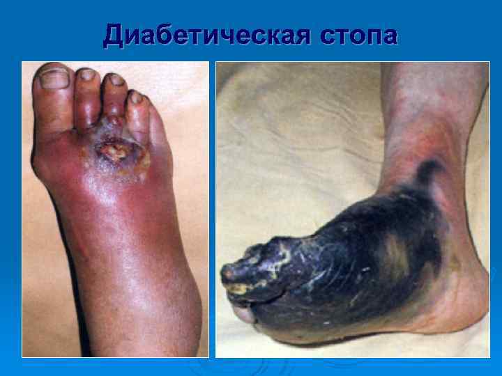 Диабетическая стопа 