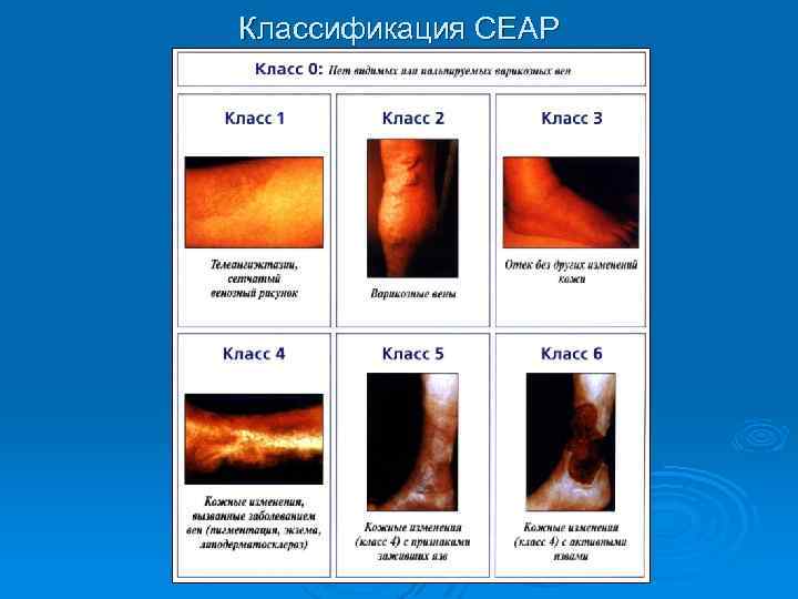 Классификация СЕАР 