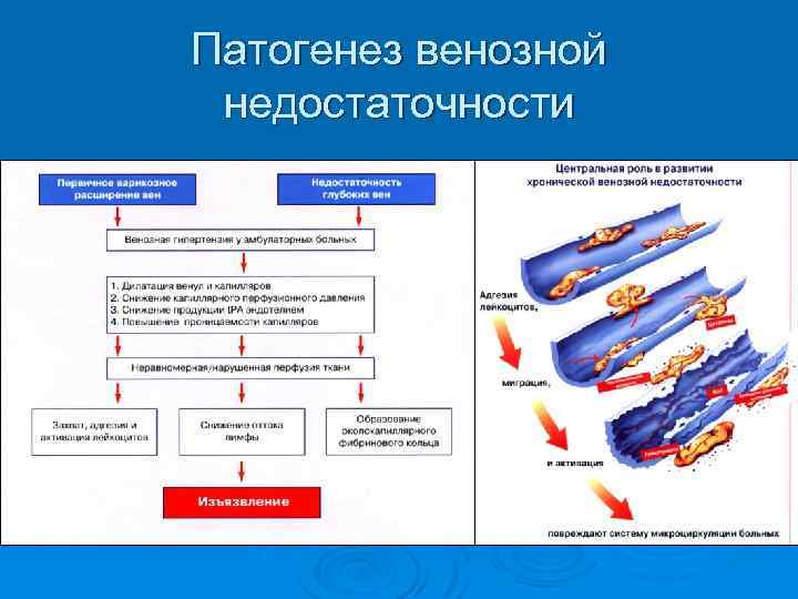 Патогенез венозной недостаточности 