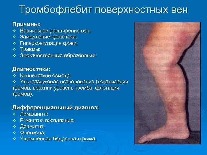 Тромбофлебит поверхностных вен Причины: v v v Варикозное расширение вен; Замедление кровотока; Гиперкоагуляция крови;