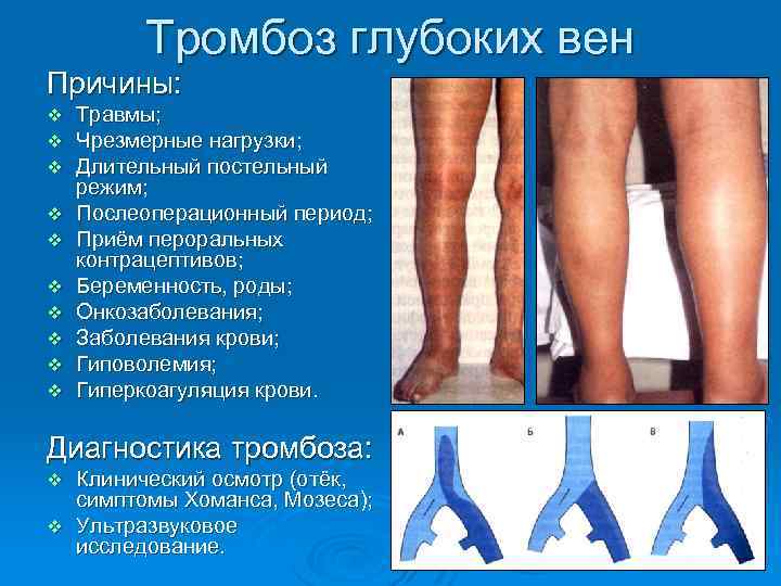 Тромбоз глубоких вен Причины: v v v v v Травмы; Чрезмерные нагрузки; Длительный постельный