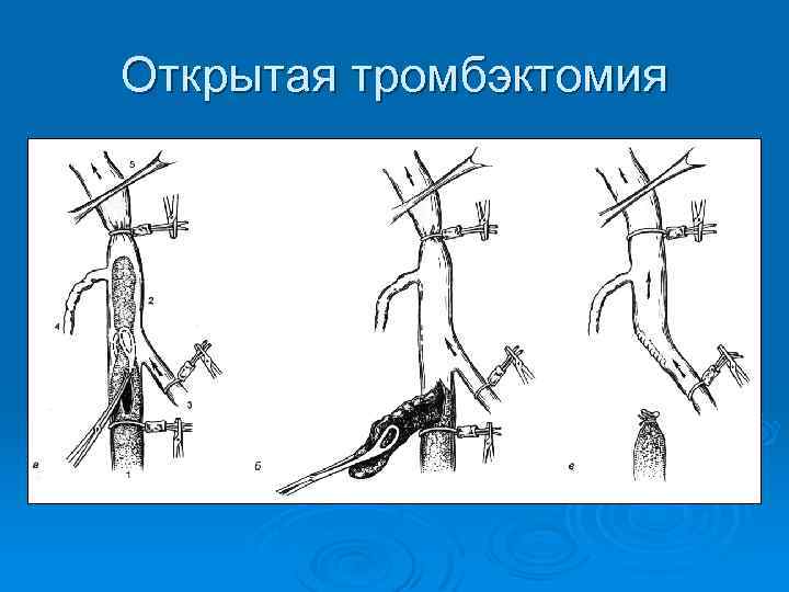 Открытая тромбэктомия 