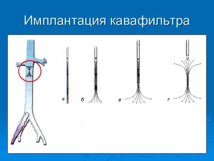 Имплантация кавафильтра 