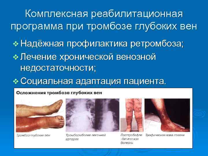 Комплексная реабилитационная программа при тромбозе глубоких вен v Надёжная профилактика ретромбоза; v Лечение хронической