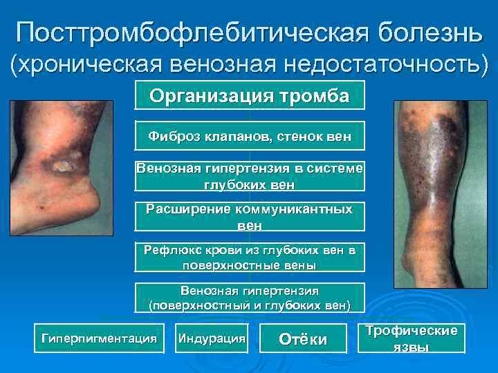 Посттромбофлебитическая болезнь (хроническая венозная недостаточность) Организация тромба Фиброз клапанов, стенок вен Венозная гипертензия в