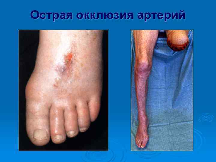 Острая окклюзия артерий 