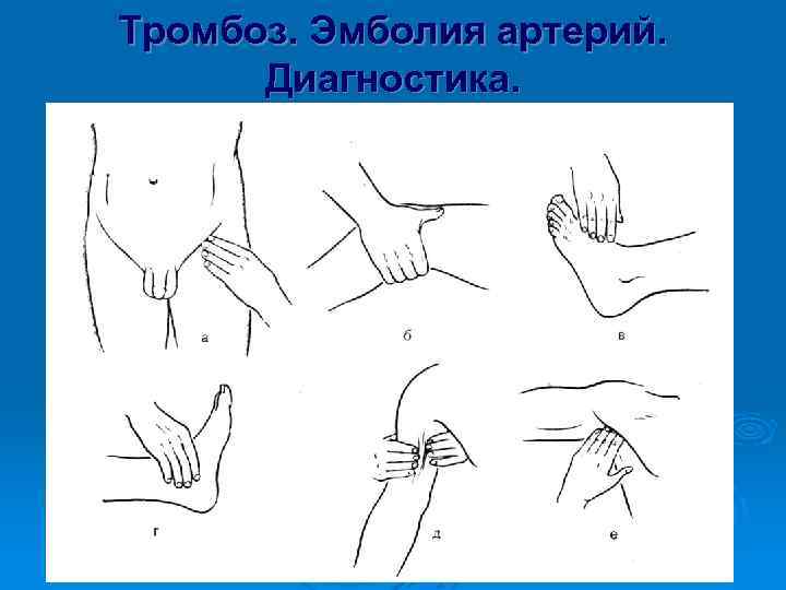 Тромбоз. Эмболия артерий. Диагностика. 1. Данные клинического осмотра • • • Исчезновение пульсации Похолодание