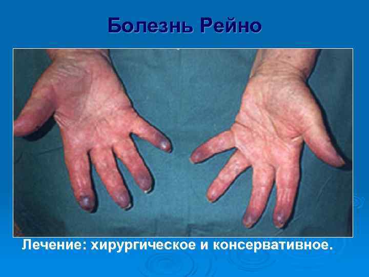 Болезнь Рейно Поражение артерий конечностей (чаще верхних) мелкого калибра; Ø Болеют чаще женщины; Ø