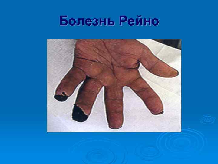 Болезнь Рейно 