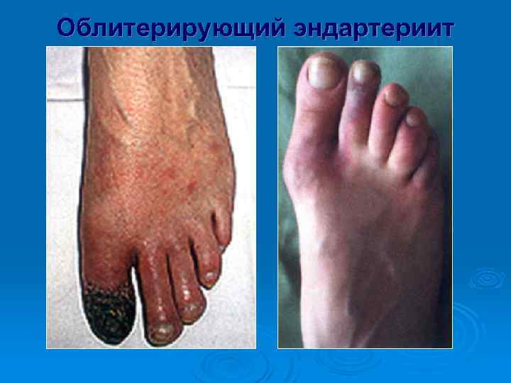 Облитерирующий эндартериит 