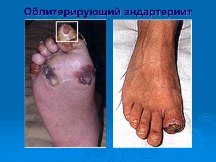 Облитерирующий эндартериит 