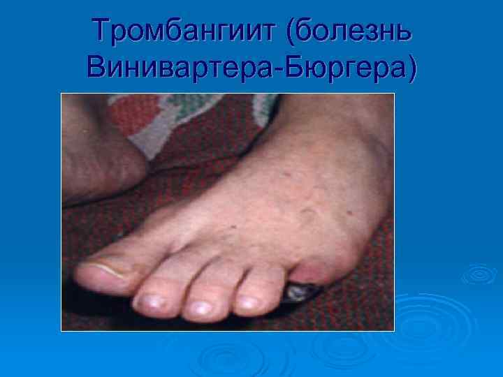 Тромбангиит (болезнь Винивартера-Бюргера) 