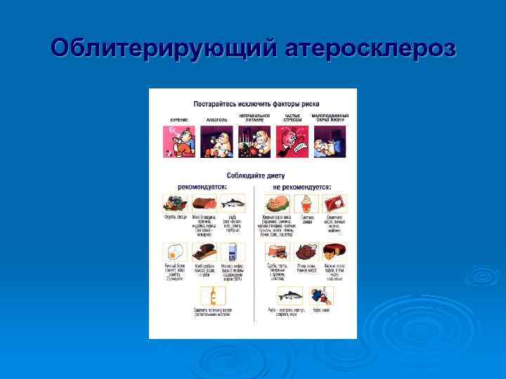 Облитерирующий атеросклероз 