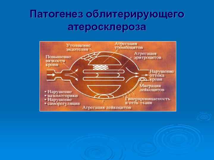 Патогенез облитерирующего атеросклероза 