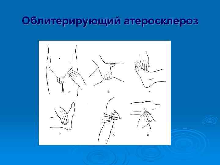Облитерирующий атеросклероз 