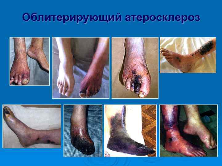 Облитерирующий атеросклероз 