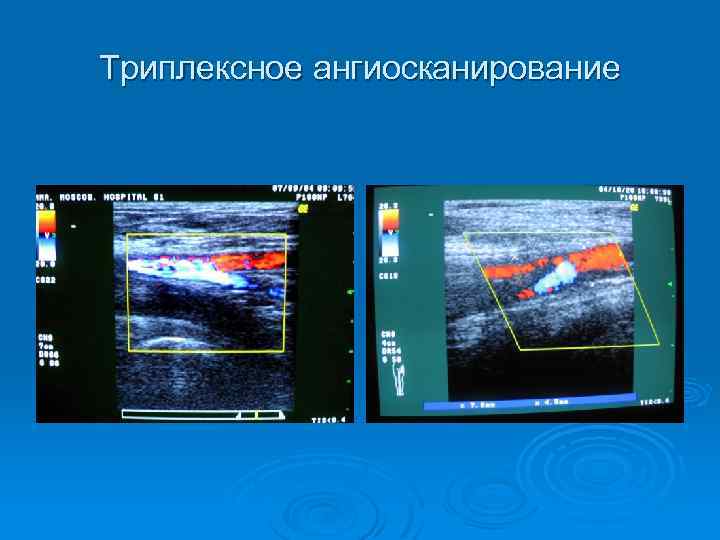 Триплексное сканирование сосудов