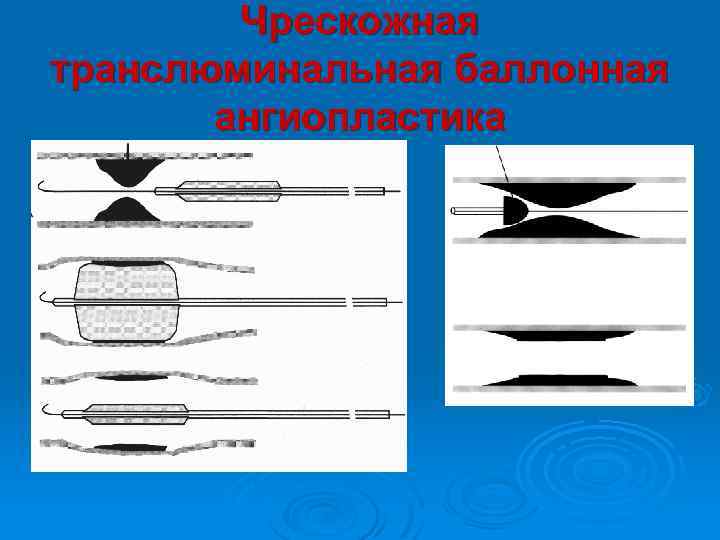 Транслюминальная ангиопластика. Чрескожная ТРАНСЛЮМИНАЛЬНАЯ баллонная. ТРАНСЛЮМИНАЛЬНАЯ баллонная ангиопластика. Чрескожная ТРАНСЛЮМИНАЛЬНАЯ коронарная ангиопластика.