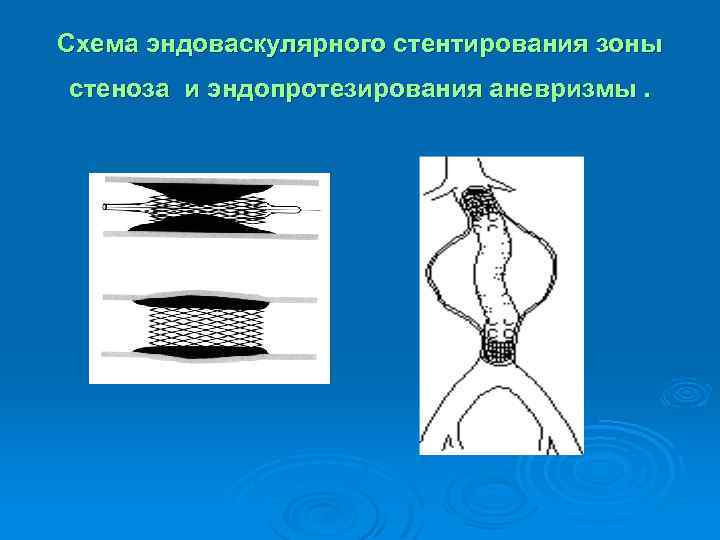 Схема эндоваскулярного стентирования зоны стеноза и эндопротезирования аневризмы. 