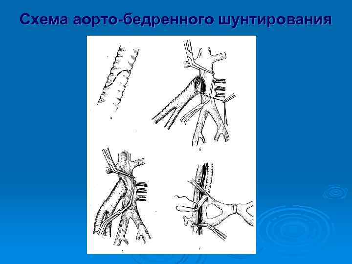 Схема аорто-бедренного шунтирования 