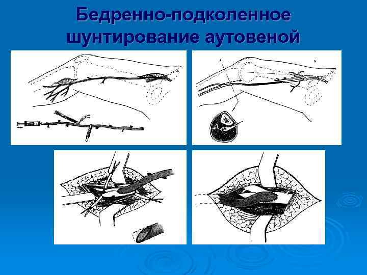 Бедренно-подколенное шунтирование аутовеной 