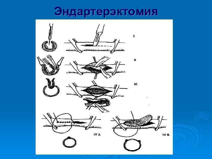 Эндартерэктомия 