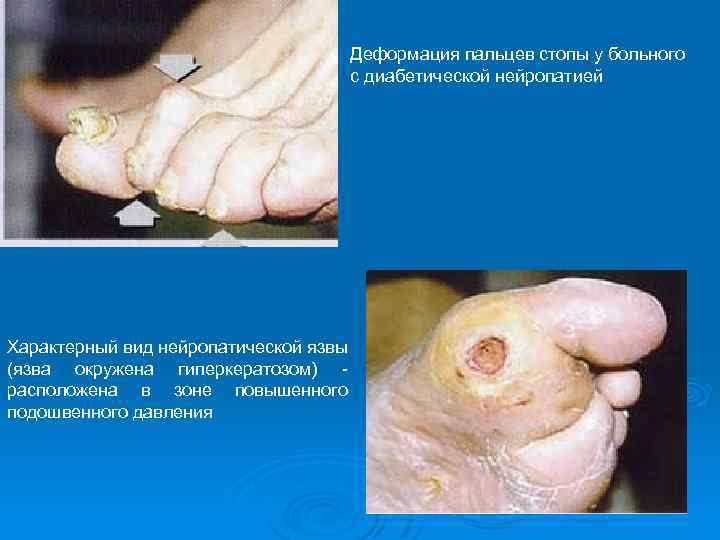 Деформация пальцев стопы у больного с диабетической нейропатией Характерный вид нейропатической язвы (язва окружена