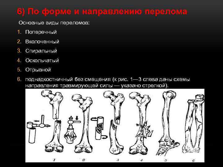 6) По форме и направлению перелома Основные виды переломов: 1. Поперечный 2. Вколоченный 3.