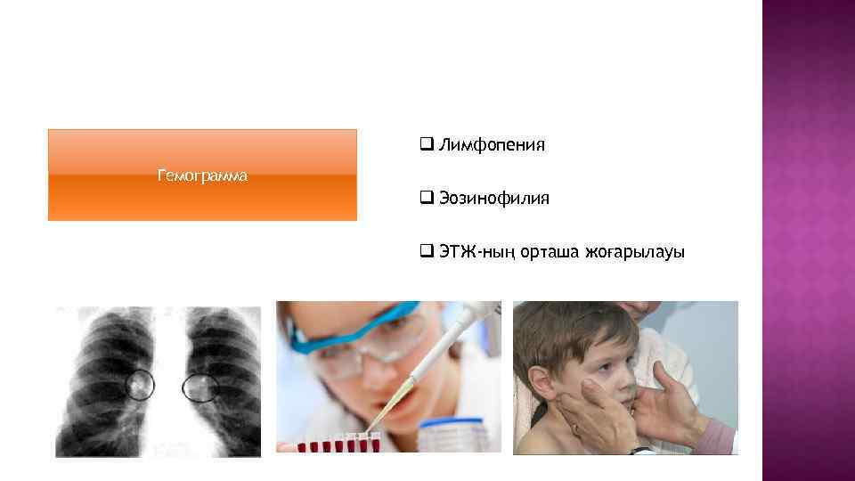 Диагностика q Лимфопения Гемограмма q Эозинофилия q ЭТЖ-ның орташа жоғарылауы 