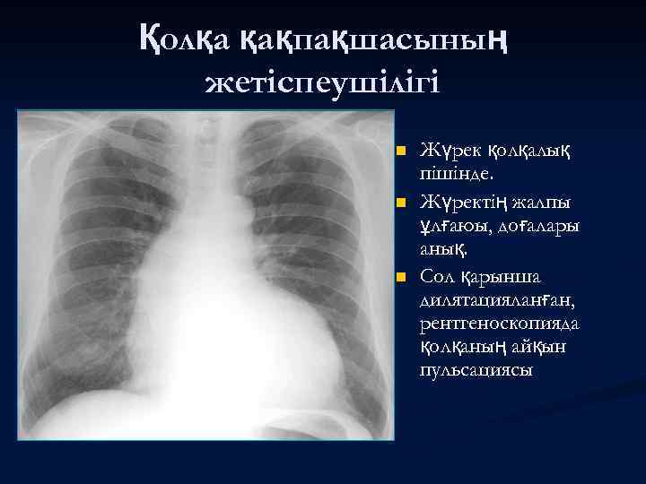 Қолқа қақпақшасының жетіспеушілігі n n n Жүрек қолқалық пішінде. Жүректің жалпы ұлғаюы, доғалары анық.