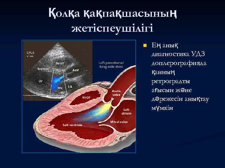 Қолқа қақпақшасының жетіспеушілігі n Ең анық диагностика УДЗ доплерографияда қанның ретроградты ағысын және дәрежесін