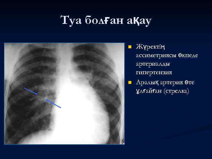 Туа болған ақау n n Жүректің ассиметриясы өкпеде артериалды гипертензия Аралық артерия өте ұлғайған