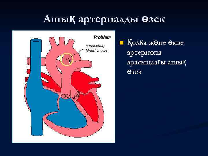 Ашық артериалды өзек n Қолқа және өкпе артериясы арасындағы ашық өзек 