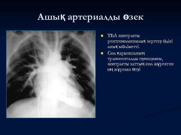 Ашық артериалды өзек n n ТБА контрасты рентгенологиялық зерттеу әдісі анық мәліметті. Сол қарыншаның