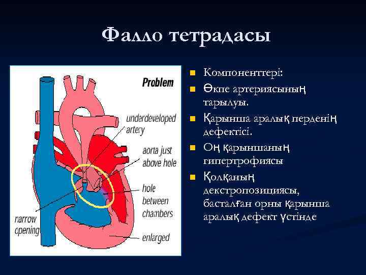 Фалло тетрадасы n n n Компоненттері: Өкпе артериясының тарылуы. Қарынша аралық перденің дефектісі. Оң