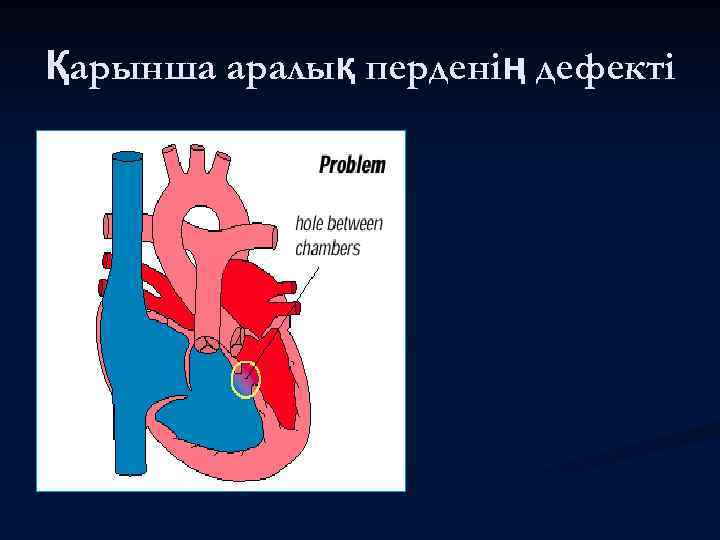 Қарынша аралық перденің дефекті 