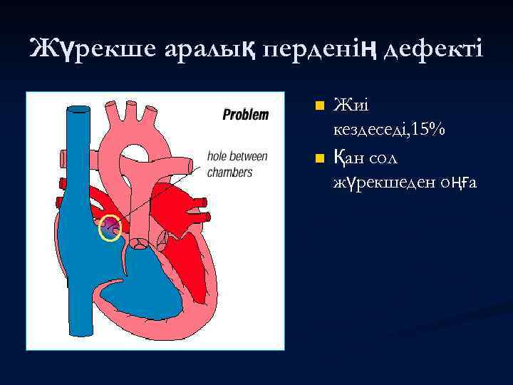 Жүрекше аралық перденің дефекті n n Жиі кездеседі, 15% Қан сол жүрекшеден оңға 