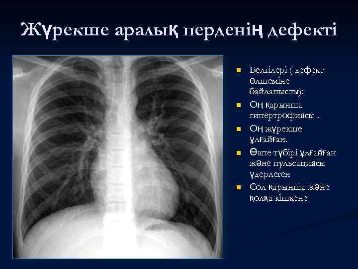 Жүрекше аралық перденің дефекті n n n Белгілері ( дефект өлшеміне байланысты): Оң қарынша