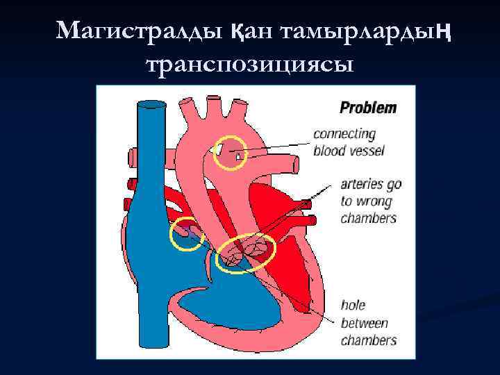 Магистралды қан тамырлардың транспозициясы 