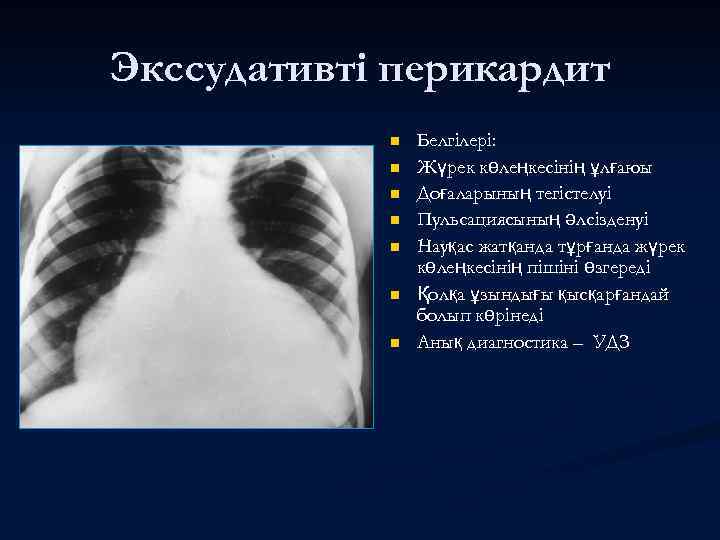 Экссудативті перикардит n n n n Белгілері: Жүрек көлеңкесінің ұлғаюы Доғаларының тегістелуі Пульсациясының әлсізденуі