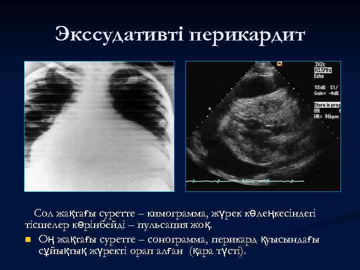 Экссудативті перикардит Сол жақтағы суретте – кимограмма, жүрек көлеңкесіндегі тісшелер көрінбейді – пульсация жоқ.