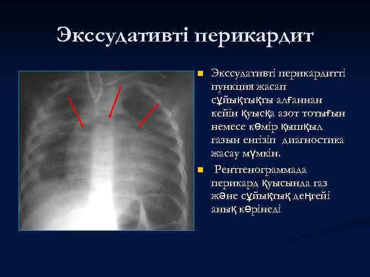 Экссудативті перикардит n n Экссудативті перикардитті пункция жасап сұйықтықты алғаннан кейін қуысқа азот тотығын