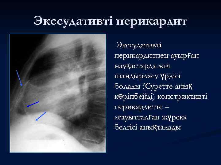 Экссудативті перикардитпен ауырған науқастарда жиі шандырласу үрдісі болады (Суретте анық көрінбейді) констриктивті перикардитте –