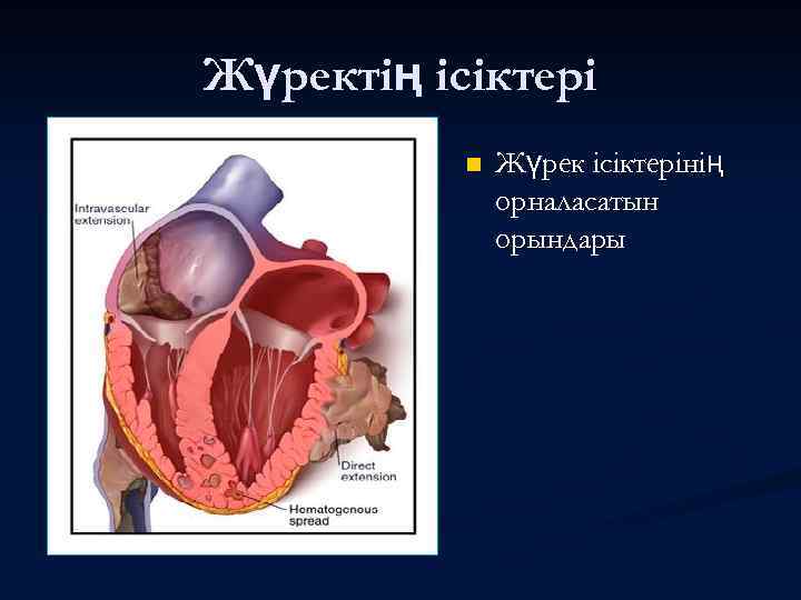 Жүректің ісіктері n Жүрек ісіктерінің орналасатын орындары 