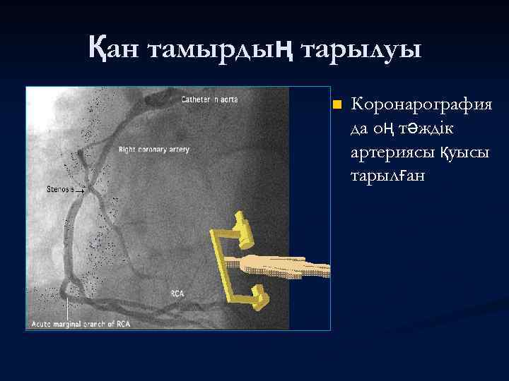 Қан тамырдың тарылуы n Коронарография да оң тәждік артериясы қуысы тарылған 