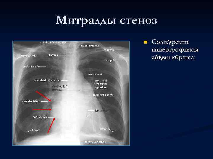 Митралды стеноз n Солжүрекше гипертрофиясы айқын көрінеді 