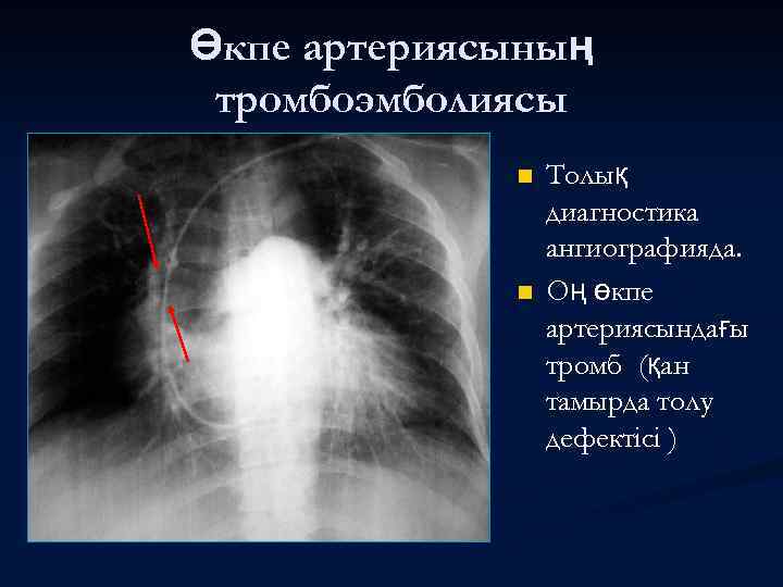 Өкпе артериясының тромбоэмболиясы n n Толық диагностика ангиографияда. Оң өкпе артериясындағы тромб (қан тамырда